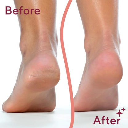 Professional Mani & Pedi Callus Remover