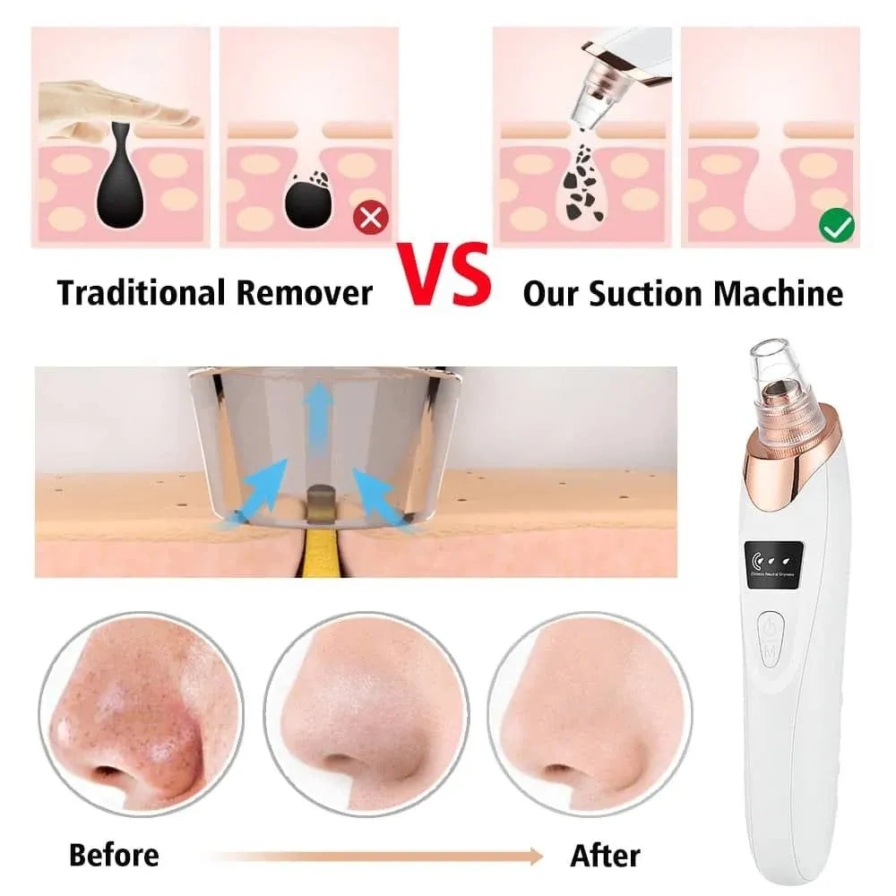 5-in-1 Electric Blackhead Remover & Pore Vacuum Cleaner