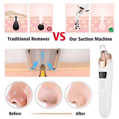 5-in-1 Electric Blackhead Remover & Pore Vacuum Cleaner